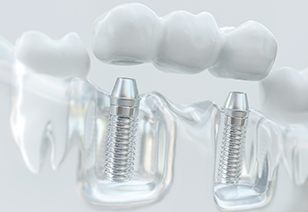an example of an implant dental bridge in New Braunfels