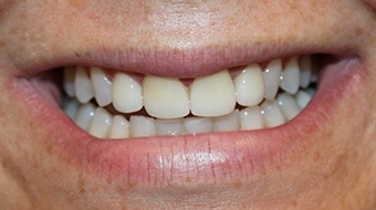 Closeup of woman's flawless smile after cosmetic dentistry