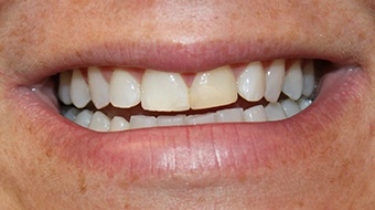 Closeup of woman's smile before cosmetic dentistry treatment