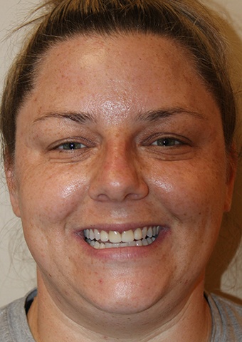 Woman's flawless smile after cosmetic dentistry