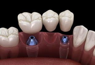Animated implant supported fixed bridge placement