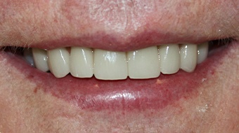 Closeup of older woman's flawless smile after cosmetic dentistry
