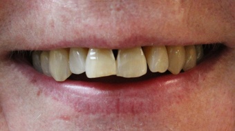 Closeup of older woman's smile before cosmetic dentistry treatment