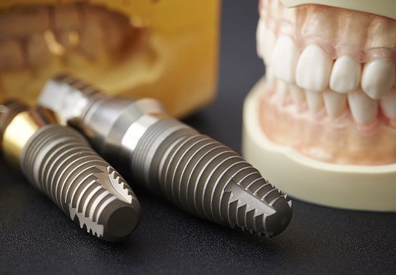 Dental implant posts and smile model