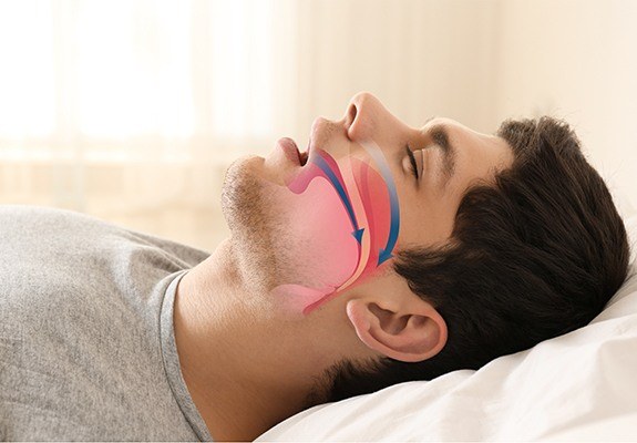 Snoring man with airway animation on his profile