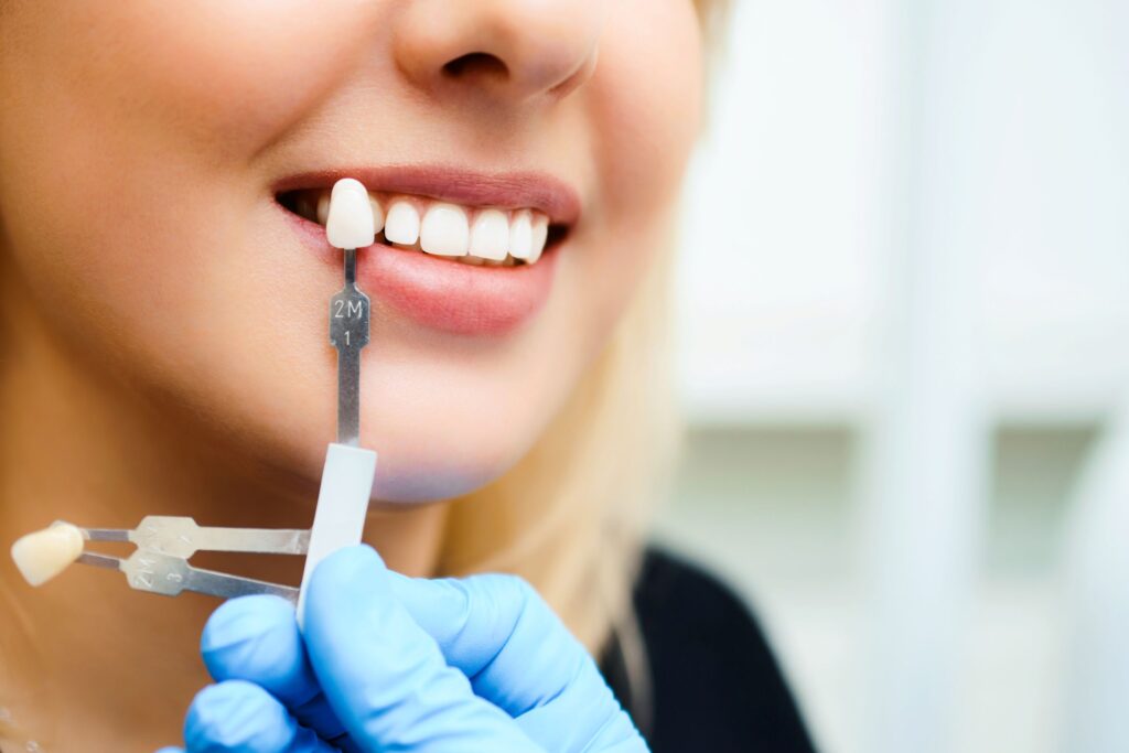 Closeup of woman's teeth with shade guide held up